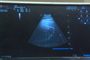 Bibi baby ultrasound