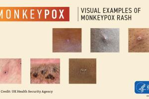 Visual Examples of Monkeypox Rash
