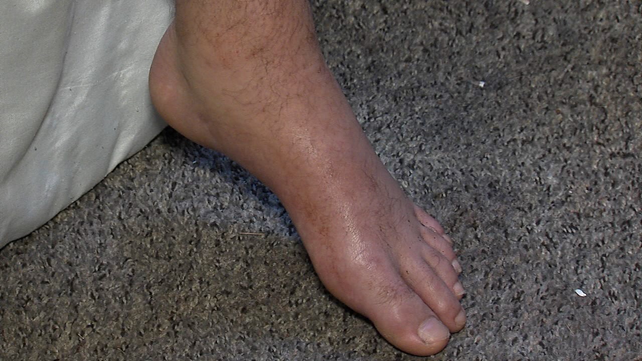 Hardin foot