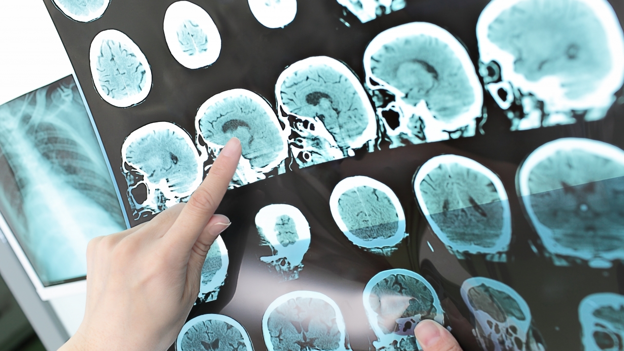 CT scan showing brain.