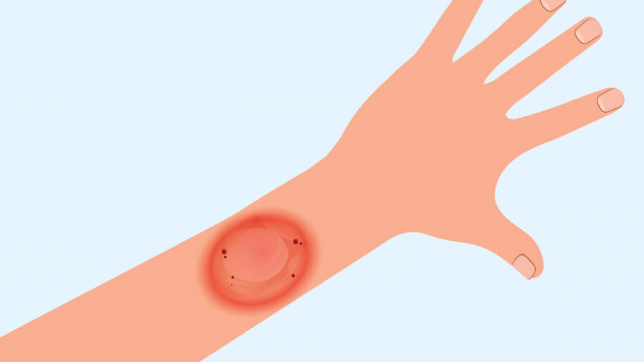 A CDC illustration of ringworm symptoms