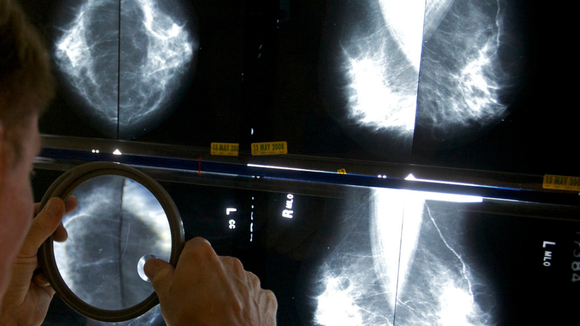 A radiologist uses a magnifying glass to check mammograms for breast cancer