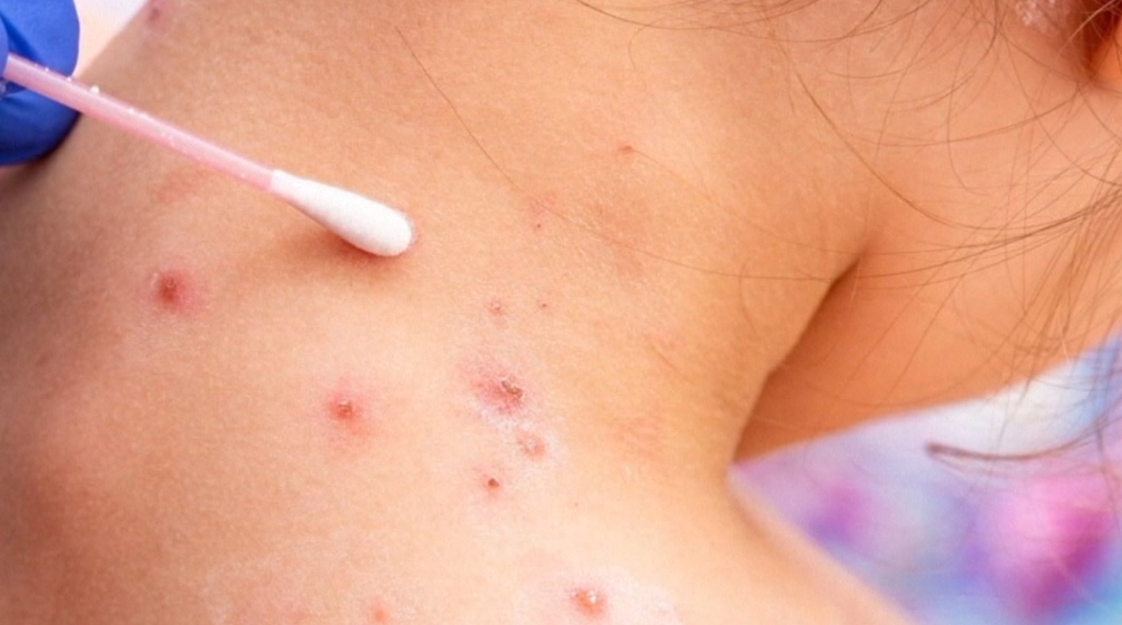 measles3.jpg