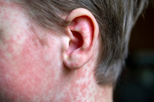 Measles